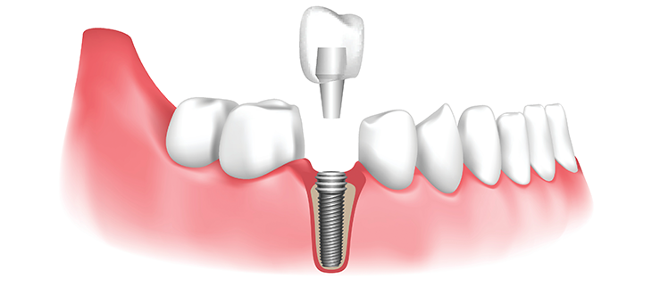 https://ankaraagizvedispoliklinigi.com/wp-content/uploads/2023/12/dental-implant1.png