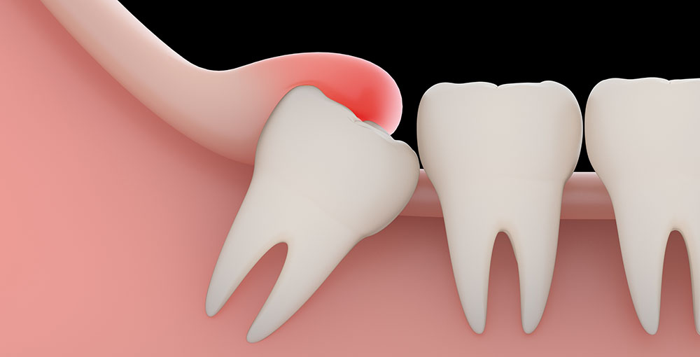20’lik diş çekimi sonrası ne yapılır ?